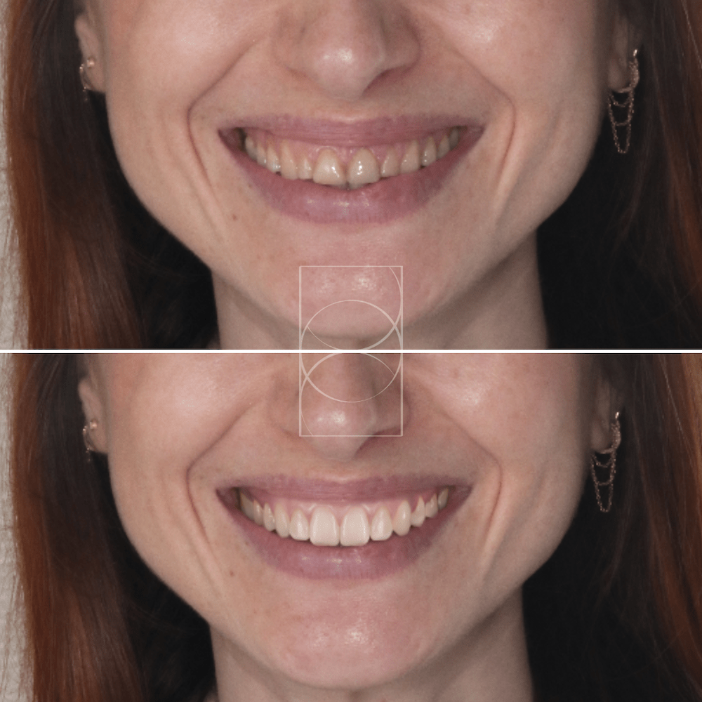 "Sourire transformé par le Digital Smile Design à Lyon, esthétique dentaire sur mesure"