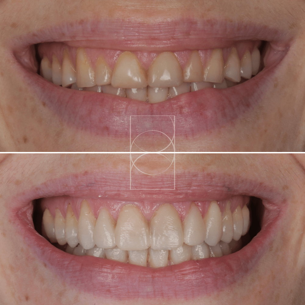 "Résultats avant et après du Digital Smile Design pour une amélioration du sourire à Lyon"