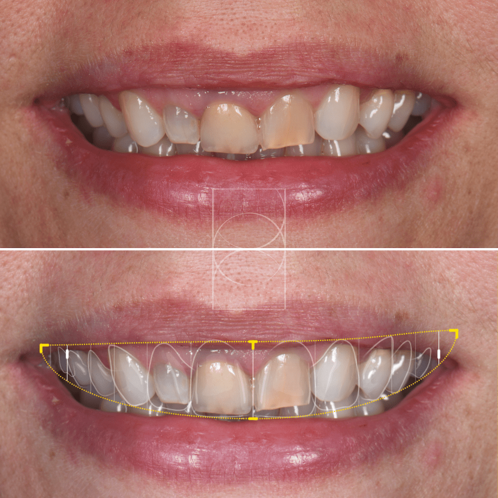 "Étapes du Digital Smile Design pour un sourire esthétique et harmonieux en dentisterie"