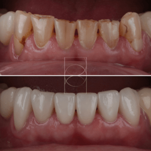 "Correction des imperfections dentaires avec facettes à Lyon – photo avant/après"