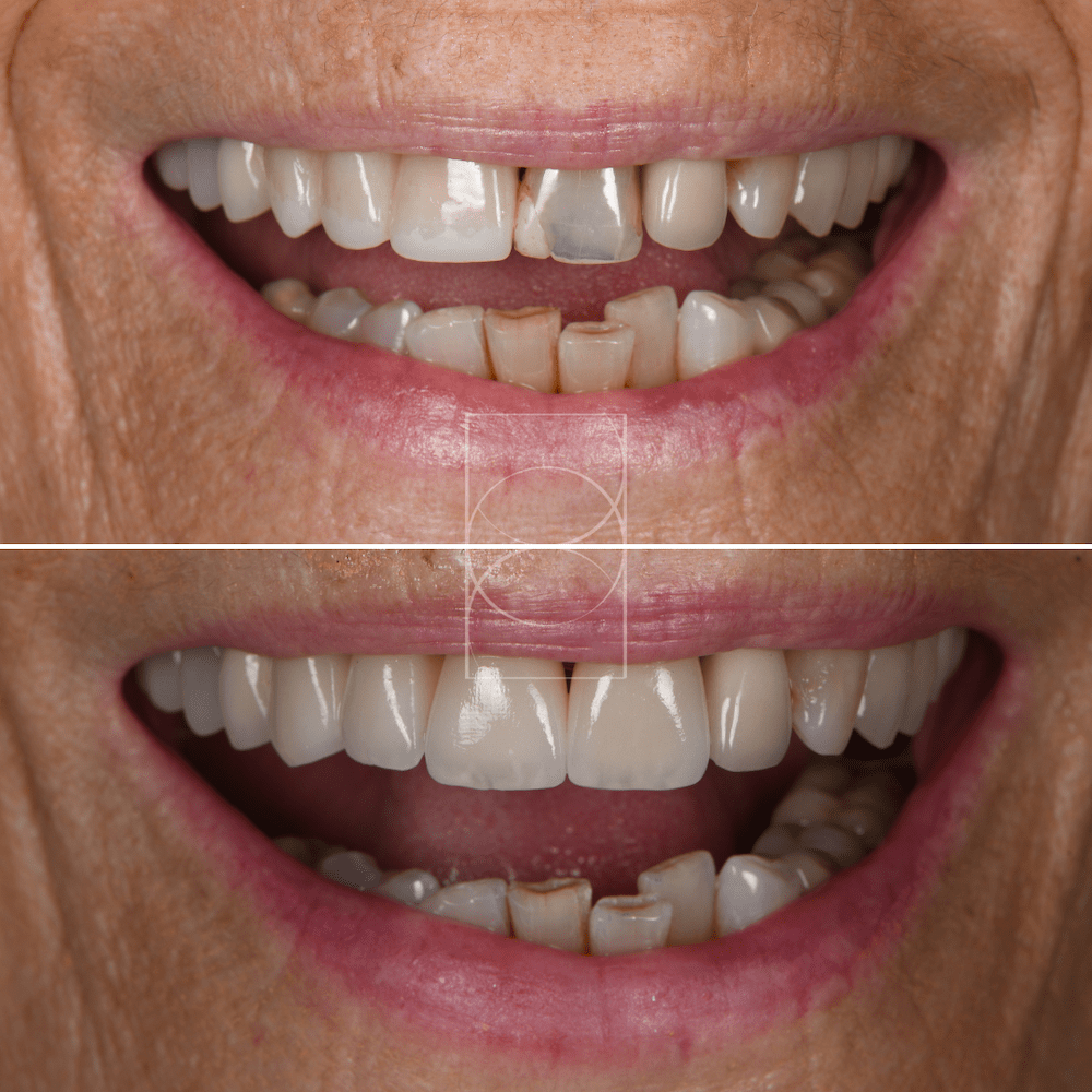 "Transformation du sourire avec facettes dentaires à Lyon – photo avant/après"