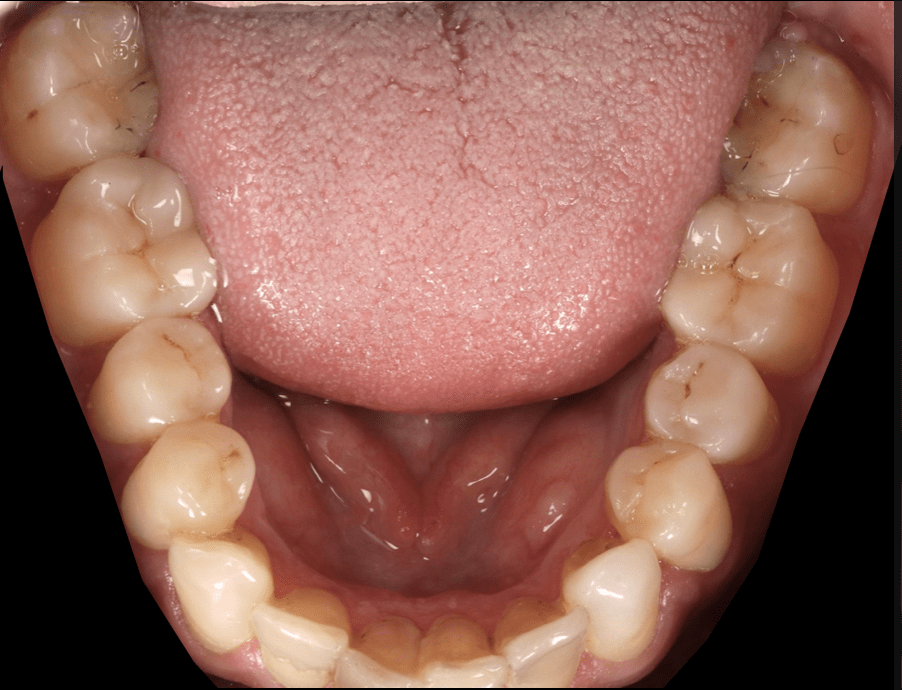 "Réhabilitation des dents usées avec composites esthétiques à Lyon"