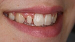 Avant-après composite esthétique sur incisive riziforme dents de devant - Cabinet Dentaire Aesthetic à Lyon