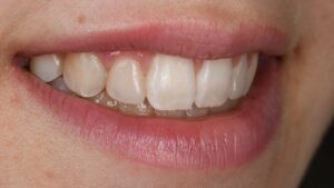 Avant-après composite esthétique sur incisive riziforme dents de devant - Cabinet Dentaire Aesthetic à Lyon