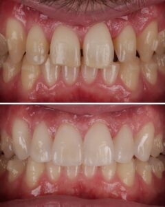 Résultat esthétique naturel après pose de facettes dentaires à Lyon – Dr Hill & Dr Salih